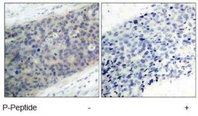 Immunohistochemistry-Paraffin: LIM kinase 2 [p Thr505] Antibody [NB100-82023] - Analysis of paraffin- embedded human breast carcinoma tissue using NB100-82023 (left) or the same antibody preincubated with blocking peptide(right).